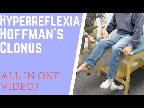 Hyperreflexia, clonus and positive Hoffman's sign