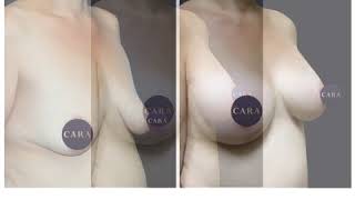 Download lagu Breast Augmentation with a Breast Lift mp3
