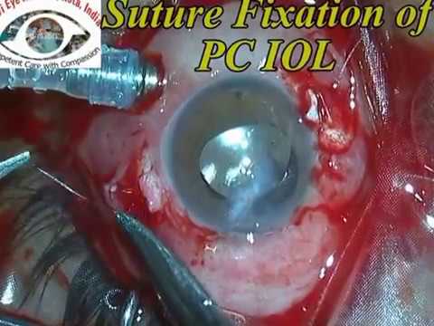 Silicone Oil Removal & Sutured Fixation of Posterior Chamber IOL