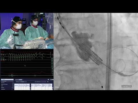 TAVI in 2025: transforming care with the new valvular heart disease guidelines - PCR London Valves