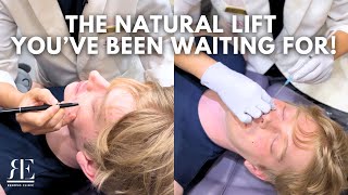 UltraCol: The Natural Lift You’ve Been Waiting For! | Renovo Skin Clinic #UltraCol