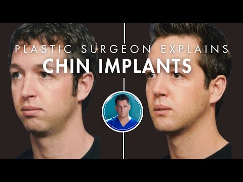 CHIN IMPLANTS EXPLAINED: experience, results, recovery, chin filler