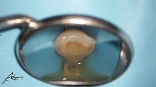 Acute Apical Abscess - Drainage abscess from root canal