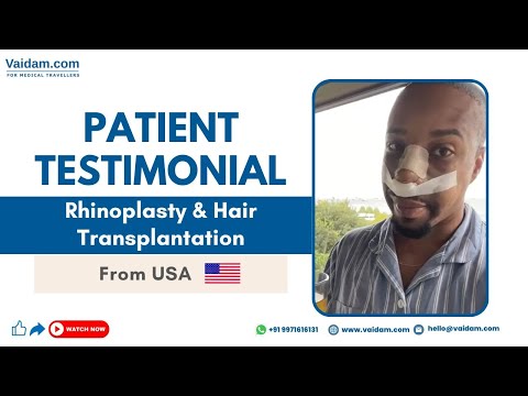 Rhinoplasty in Turkey | Satisfied Patient from USA