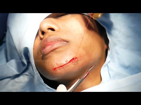Face Scar Removal Surgery