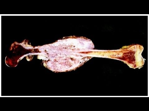 Guzki na zewnętrznej stronie stóp Ćwiczenie ustawień koślawości stóp u dzieci