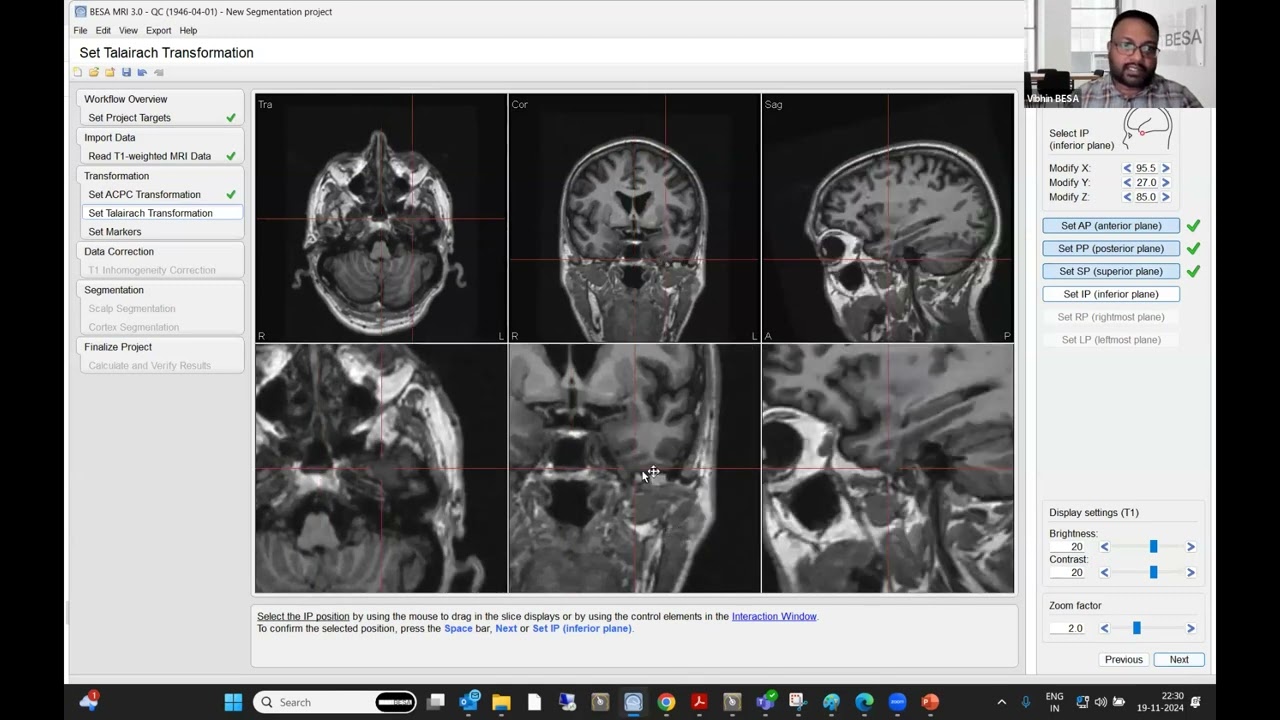 Segmentation of human head MRI data with BESA MRI