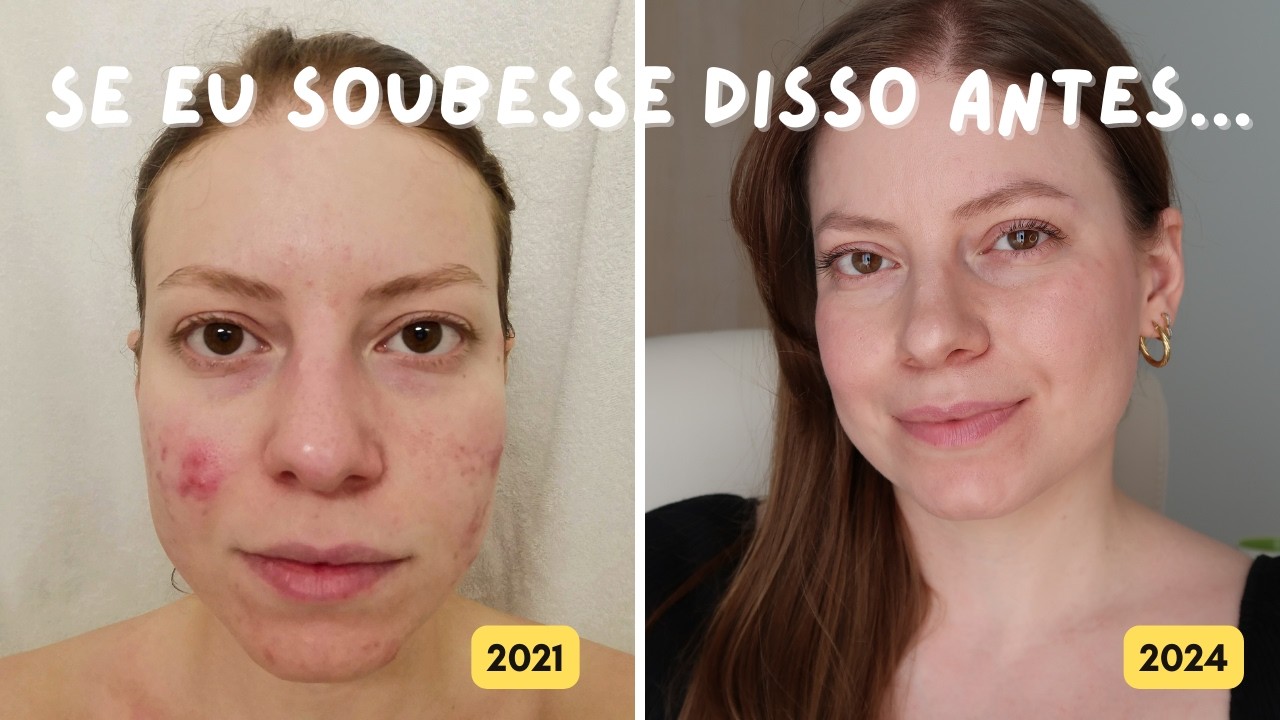 Espinhas Inflamadas: o que você precisa saber para controlar a acne (e o deve e NÃO deve fazer!)