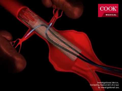 Fenestrated Endovascular Graft to Repair Abdominal Aortic Aneurysm