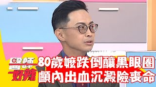 80歲阿嬤跌倒出現黑眼圈！竟是顱內出血沉澱險喪命！【#醫師好辣】202301014 EP1574 part3