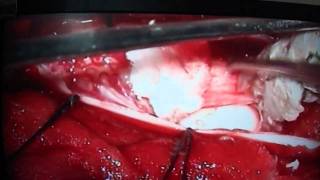 preview picture of video 'intradural epidermoid tumor of thoracic spinal cord'