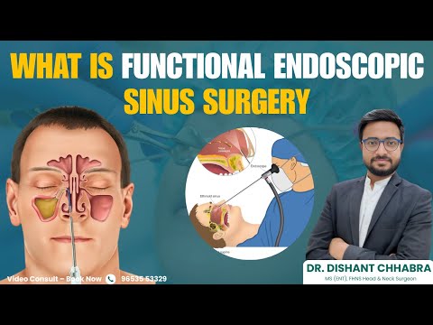 What is Functional Endoscopic Sinus Surgery FESS    Dr  Dishant Chhabra   ENT Specialist Explains