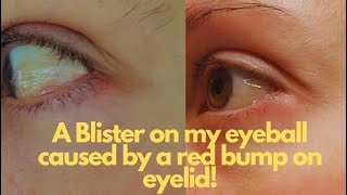 Blister// bubble on my eyeball caused by a red bump which I thought was a stye (Chalazion/ Chemosis)