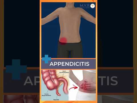 Appendix : குடல் வால் வெடிக்கும் அபாயம் #appendix #appendicitis