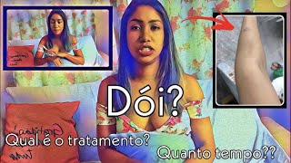 ESPOROTRICOSE EM HUMANOS - MEU RELATO NA REAL - Lu Sirqueira