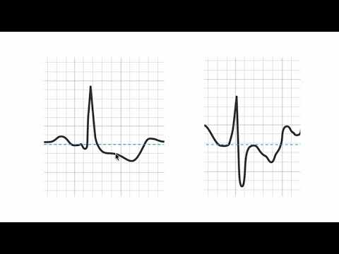 How to tell if a stress ECG (EKG) is positive?