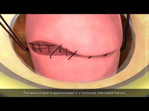 Caesarean section in patients with an elevated BMI