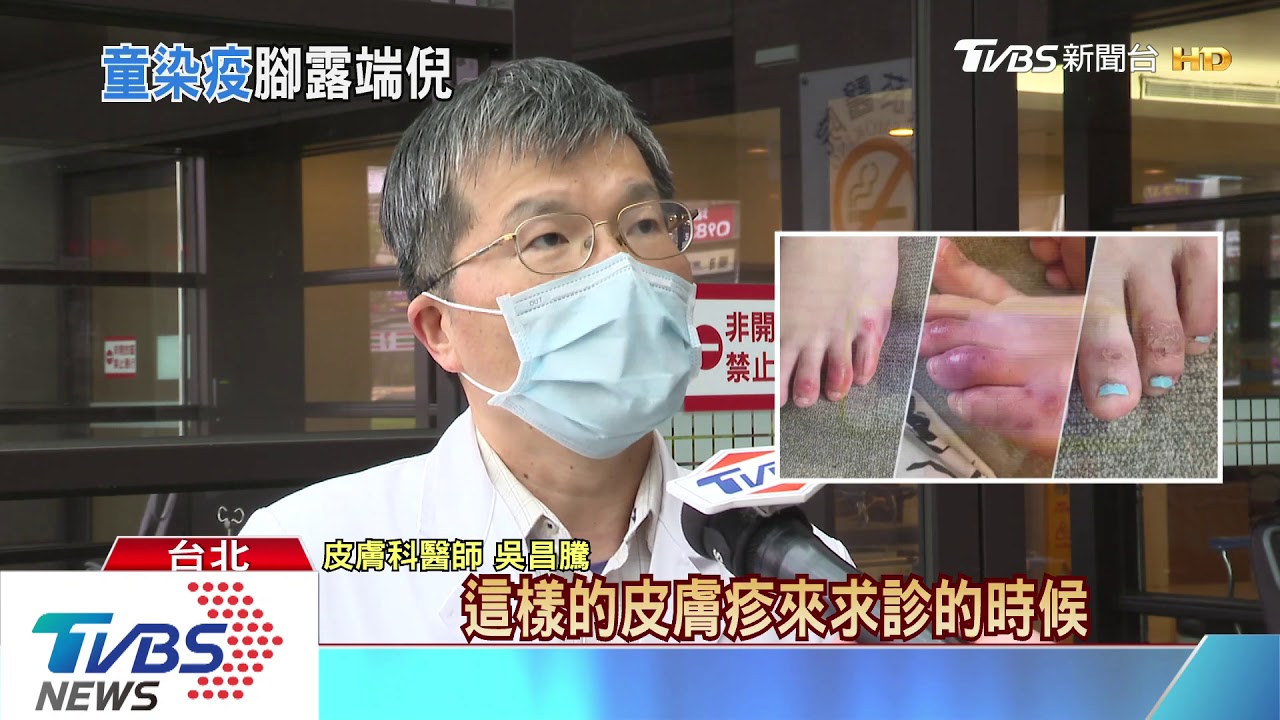腳趾凍瘡、皰疹！　美研究「無症狀者」確診徵兆