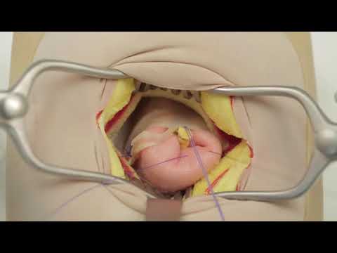 Open Appendectomy technique // for 1st year General Surgery Residents // Simple concepts