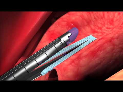 Animation   Endo GIA™ Reinforced Reload with Tri Staple™ Technology    Chapter 3 orSo6xtt1DI