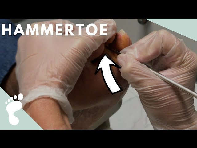 Wymowa wideo od capsulotomy na Angielski