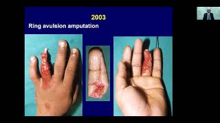 Lessons learnt over the 30years of Microsurgery | ALAM (2021)