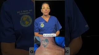 Spontaneous fasciculations #lougehrigsdisease #ALS #musclespasm, #pinchednerve #EMG