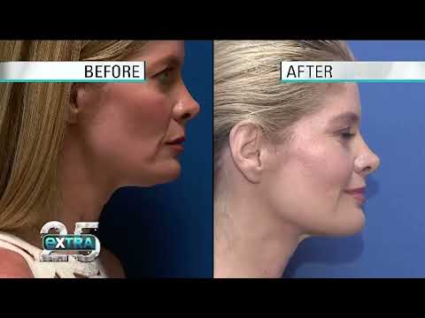 Szkolenie w klinice Lift-Med z działania aparatu EmbraceRF Inmode; prowadzący dr Salvatore Pagano