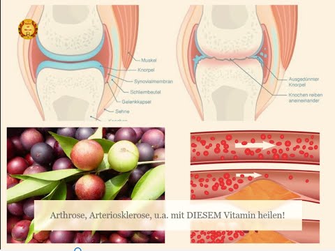 Arthrose, Arteriosklerose, u.a. mit DIESEM Vitamin heilen!