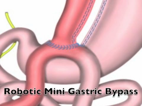 Robotic mini gastric bypass bariatric surgery