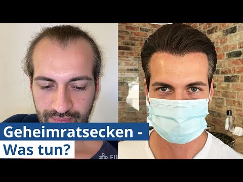 Haartransplantation bei Geheimratsecken: Das musst du wissen!