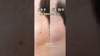 여드름 흉터 이 3가지만 기억하세요☑️