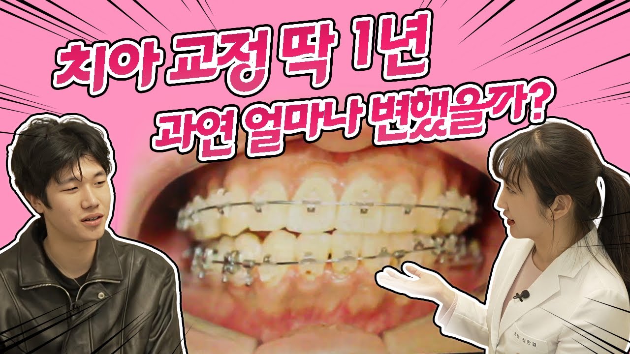 整整一年的牙齒矯正歷程成果！