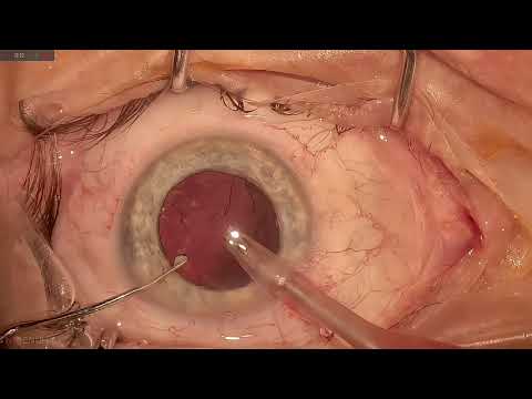 Técnica de Taco Chop — Facoemulsificação