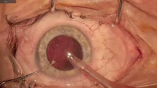 Técnica de Taco Chop — Facoemulsificação