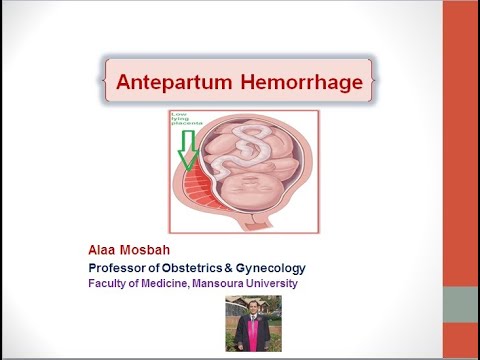 Antepartum Hemorrhage
