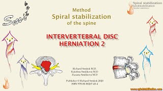 SPS METHOD - INTERVERTEBRAL DISC HERNIATION
