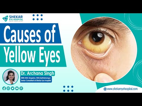Causes of Yellow Eyes | Yellow Eyes Treatment in Bangalore | Shekar Eye Hospital