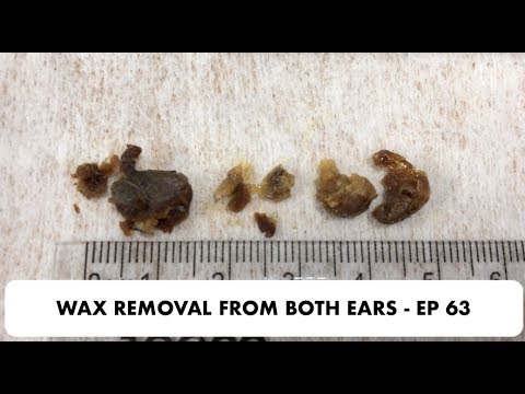 EAR WAX REMOVAL FROM BOTH EARS - EP 63