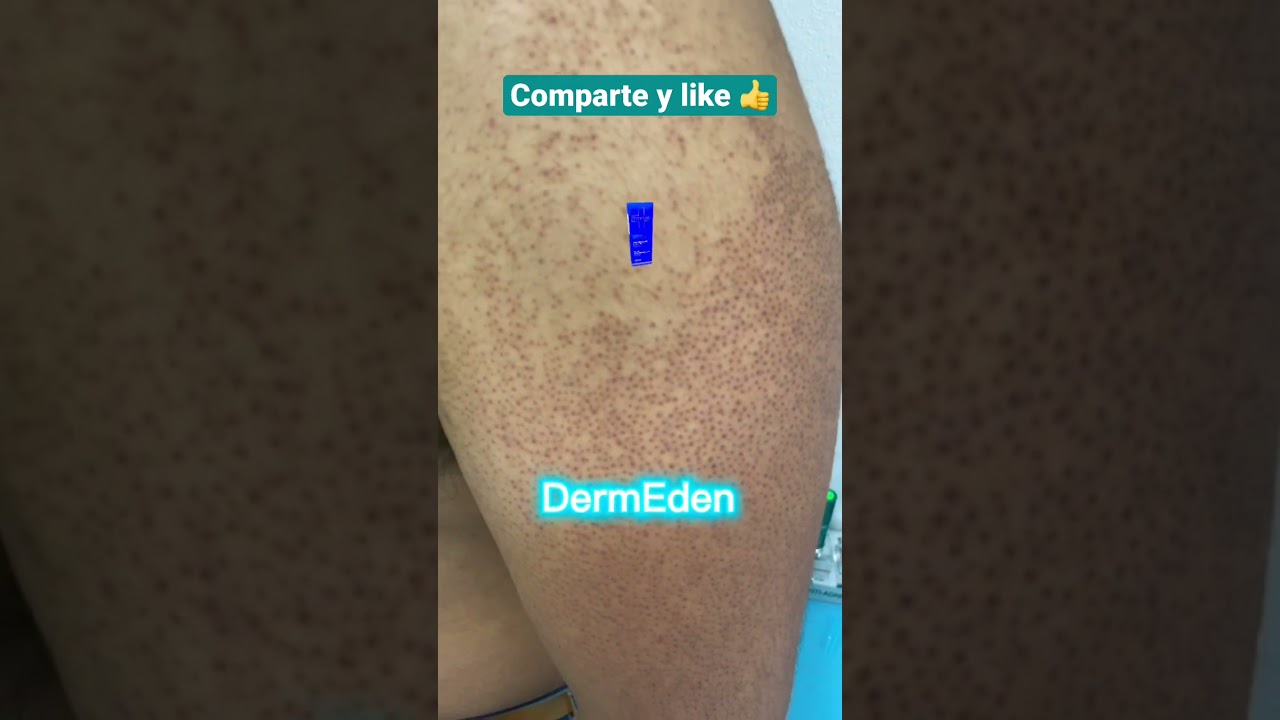 Watch 🤩Consigue disminuir la queratosis pilar o piel de gallina 🐓 con DermEden protocolo de estrías Now 🤩Consigue disminuir la queratosis pilar o piel de gallina 🐓 con DermEden protocolo de estrías