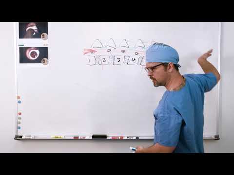 Why MIS-TLIF Spine Surgery is Needed | Post Operation | Transforaminal Lumbar Interbody Fusion