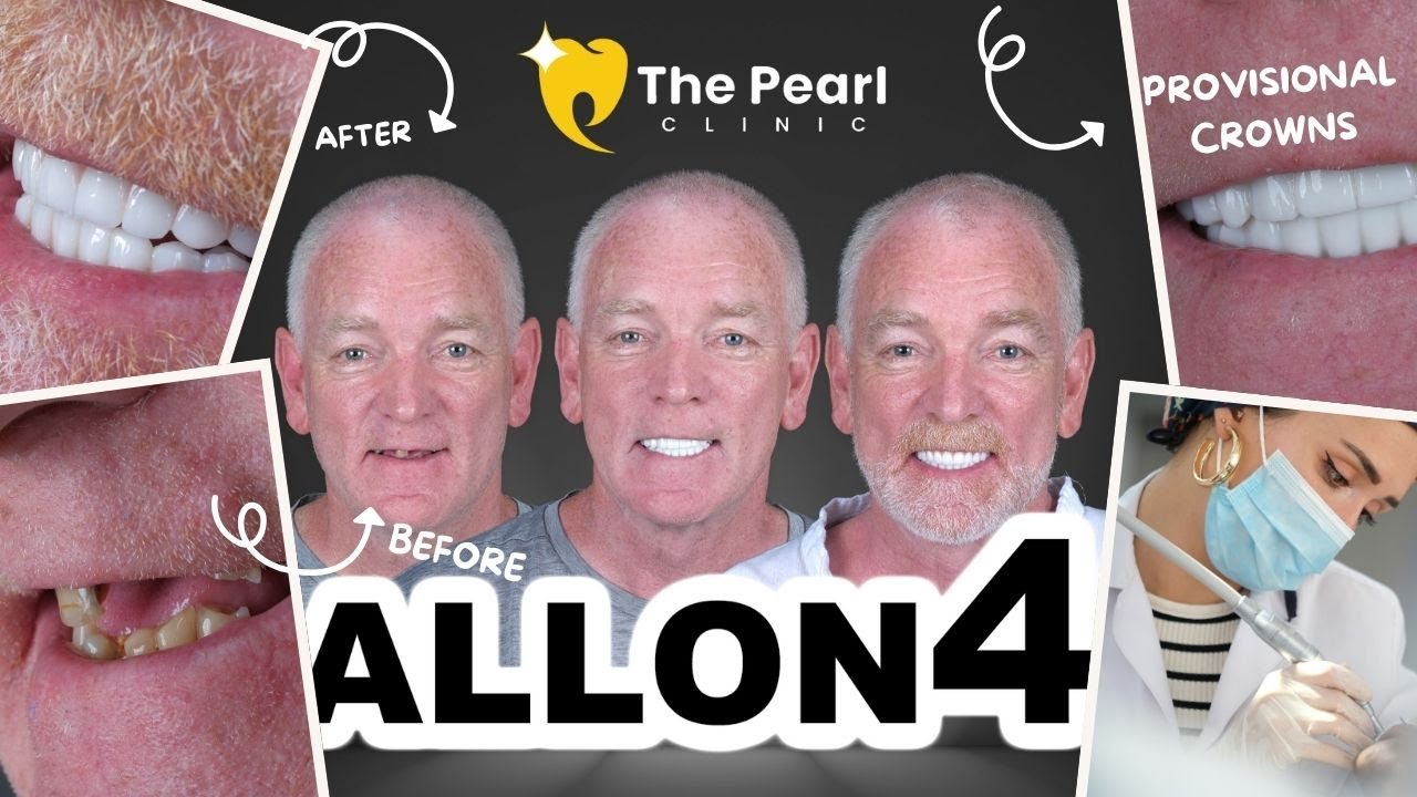 All-on-6  – BL3 -Natural Style - Video