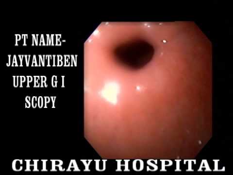 big gastric ulcer 1