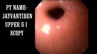 big gastric ulcer 1