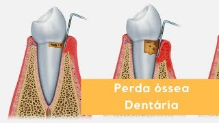 Perda óssea Dentária