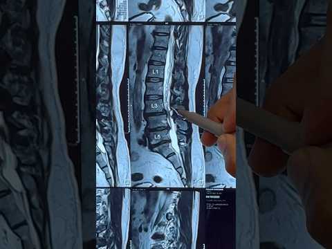 Lumbar canal stenosis and Listhesis Treatment|Dr Ajay Kothari