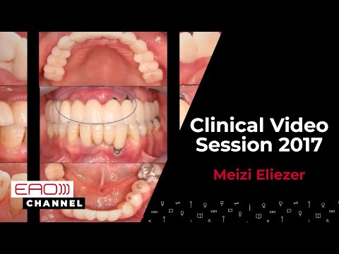 Periimplantitis - non-surgical treatment by diode laser w/ Meizi Eliezer|Clinical Video Session 2017