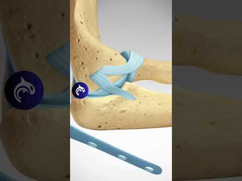 Elbow Olecranon Fracture and Fixation 3D Animation