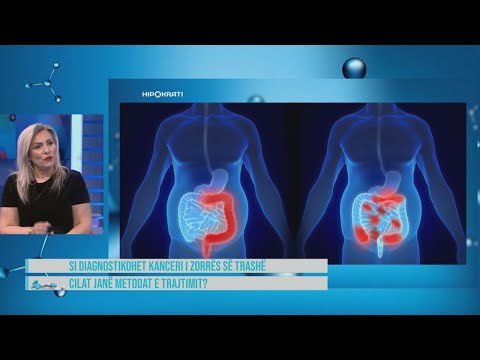 Hipokrati- Kriza të forta barku në anën e majtë? Mund të keni tumor…