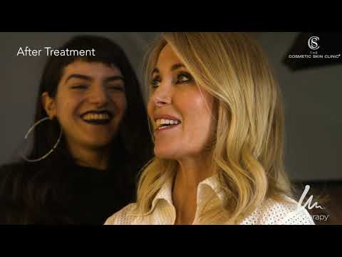 Belle on Ultherapy®